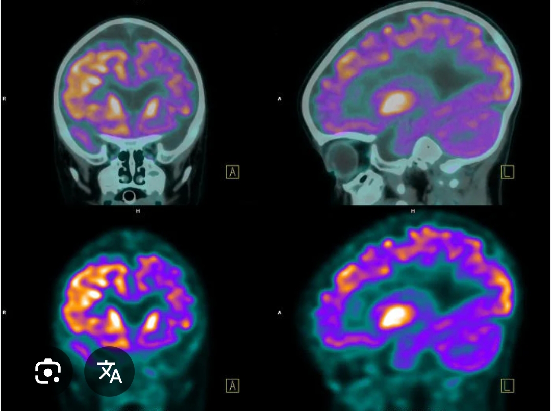 <p>attraverso 3 fasi fondamentali:</p><p>somministrazione del radioisotopo</p><p>rilevazione della radiazione</p><p>elaborazione di immagini al computer</p><p>i radioisotopi si distribuiscono nel corpo e vengono assorbiti selettivamente</p><p></p>