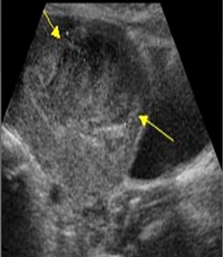 <p>Leiomyosarcoma can affect any age group but most common in women ____-____ yrs of age</p>
