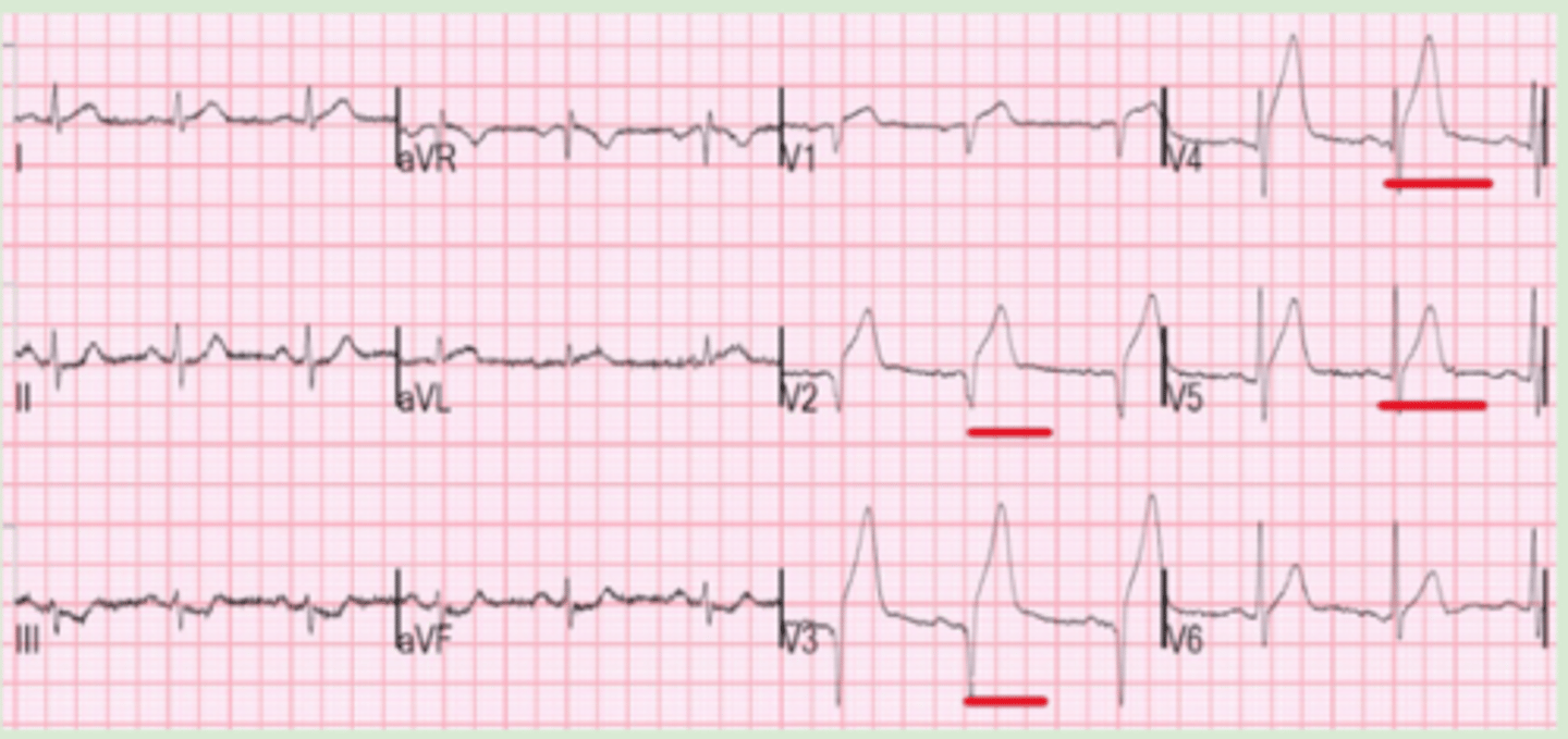 <p>ST elevation in leads V3 and V4</p>