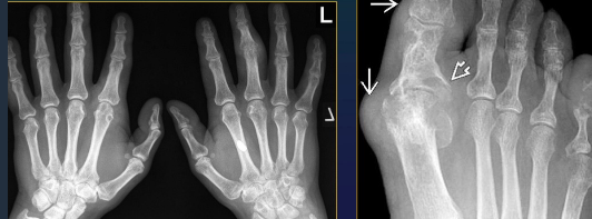 <ul><li><p>Rx</p></li><li><p>Soft tissue masss, NO tophi => MRI</p></li></ul><p></p>