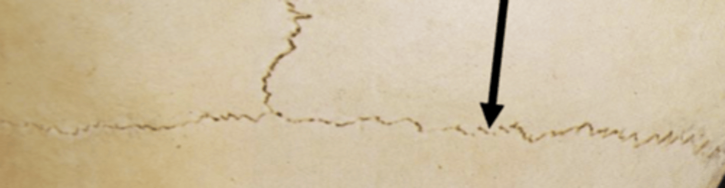 <p>coronal suture</p>