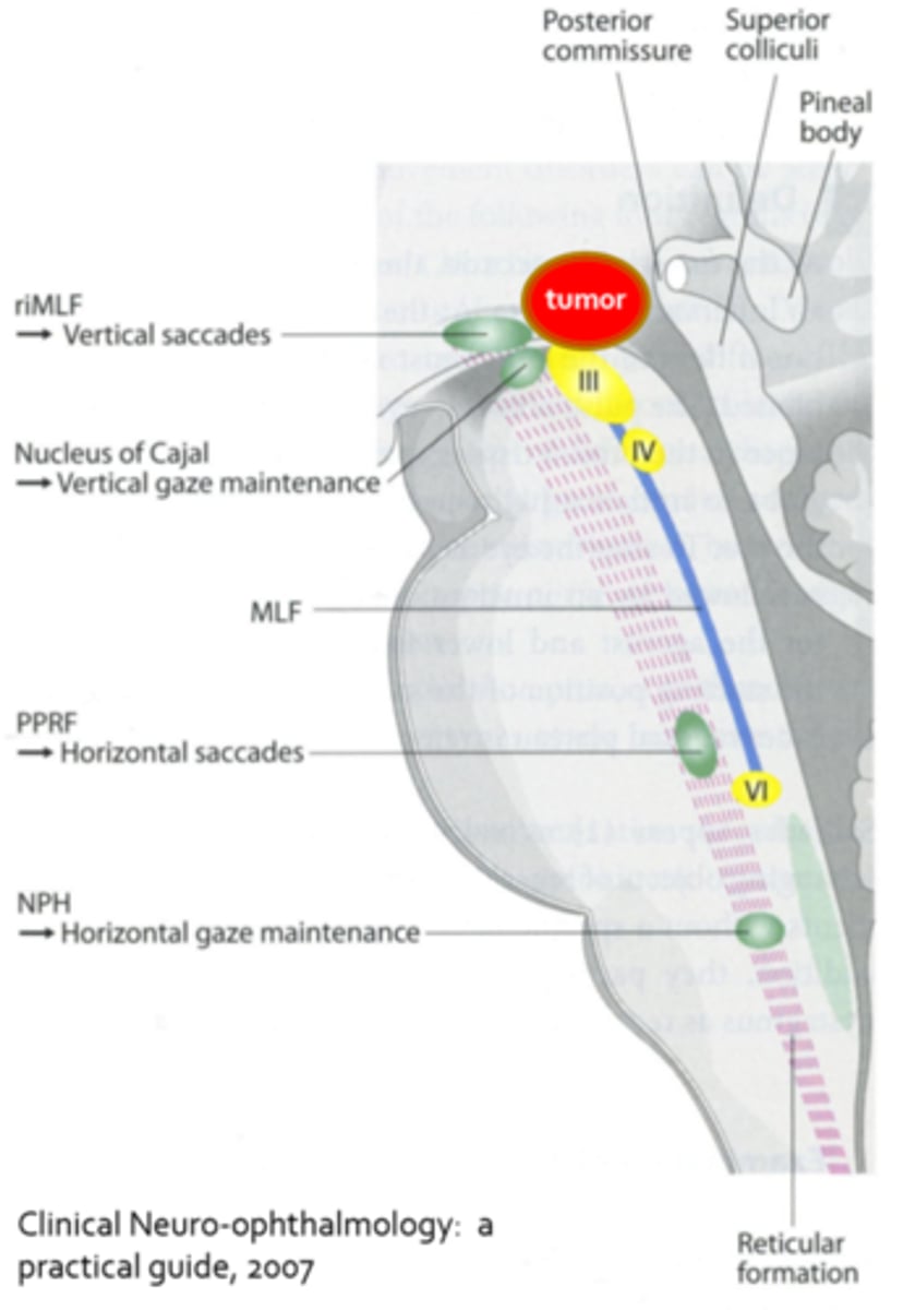 <p>CNS lesion (tumor, MS, stroke, etc) causing compression on dorsal midbrain, affecting the...</p><p>superior colliculus = coordinating eye movement, convergence</p><p>MLF = vertical saccades</p><p>nucleus of Cajal = vertical gaze maintenance</p>