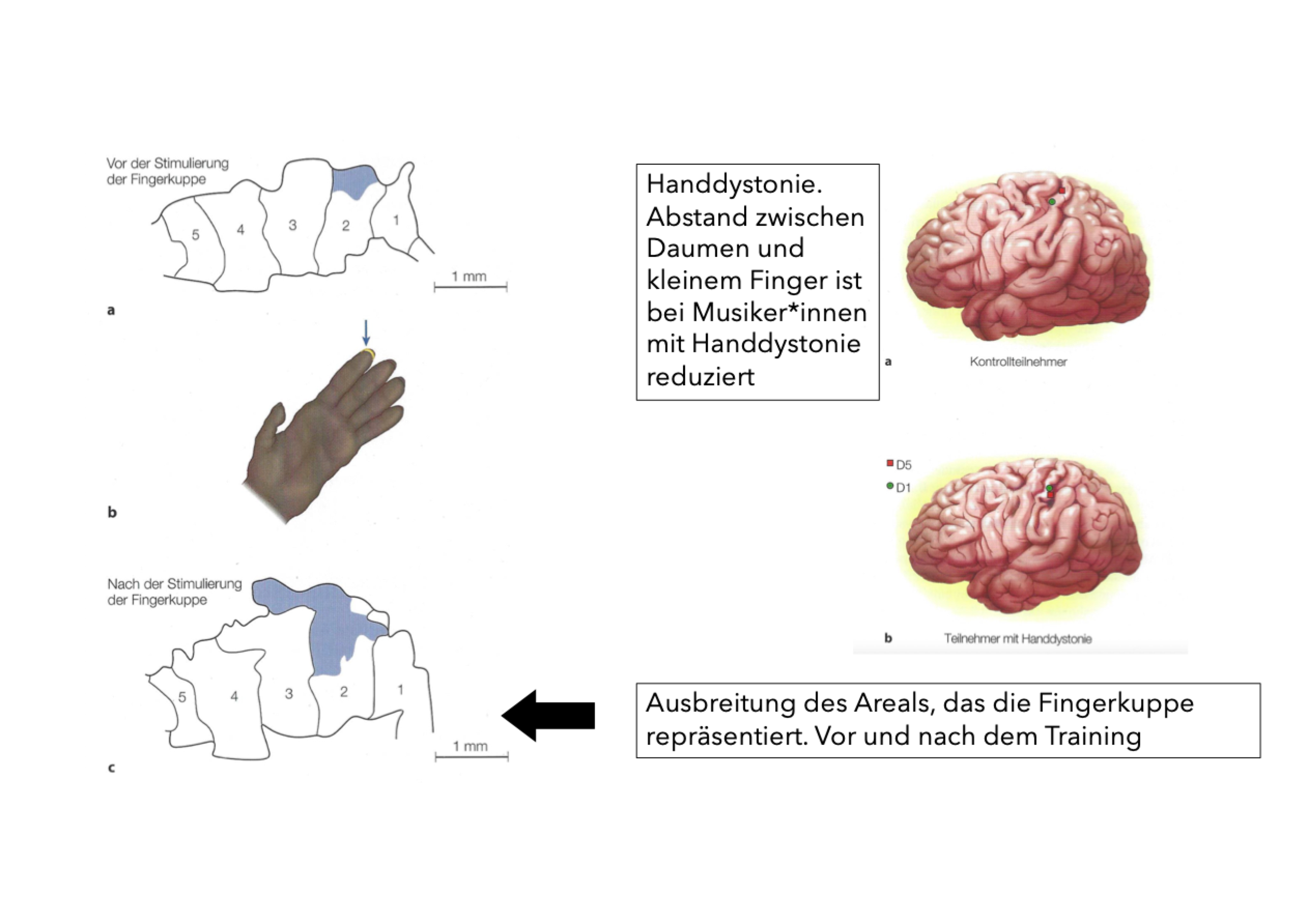 <p class=""><span data-name="brain" data-type="emoji">🧠</span><strong> Short summary:</strong><br><strong>Hand dystonia</strong> is a disorder where <strong>intense, repetitive hand use</strong> (like in pianists) causes the <strong>motor cortex’s finger maps to blur or overlap</strong>, leading to <strong>loss of fine motor control</strong> and <strong>involuntary finger movements</strong>.</p><div data-type="horizontalRule"><hr></div><p class=""><span data-name="clipboard" data-type="emoji">📋</span><strong> Long summary:</strong></p><ul><li><p class=""><strong>Cause:</strong></p><ul><li><p class="">Triggered by <strong>excessive, repetitive use</strong> of the hand (e.g., practicing an instrument for hours daily).</p></li><li><p class="">Common in <strong>musicians</strong>, especially pianists and violinists.</p></li></ul></li></ul><p class=""></p><ul><li><p class=""><strong>Brain mechanisms:</strong></p><ul><li><p class="">In the <strong>motor cortex</strong>, each <strong>finger normally has its own distinct representation</strong>.</p></li><li><p class="">In <strong>hand dystonia</strong>, these <strong>representations merge or shift</strong>, making it <strong>hard for the brain to separate finger control</strong>.</p></li><li><p class="">This is due to <strong>maladaptive neuroplasticity</strong>—the brain’s learning system misfires due to overtraining.</p></li></ul></li></ul><p class=""></p><ul><li><p class=""><strong>Symptoms:</strong></p><ul><li><p class=""><strong>Loss of fine motor control</strong></p></li><li><p class=""><strong>Involuntary muscle contractions</strong></p></li><li><p class=""><strong>Cramping or curling of fingers</strong></p></li><li><p class="">Can make tasks like playing piano <strong>impossible</strong>, despite no muscle damage.</p></li></ul></li></ul><p class=""></p><ul><li><p class=""><strong>Example:</strong></p><ul><li><p class=""><strong>Leon Fleisher</strong>, a world-class pianist, developed dystonia and could only use his left hand for decades until therapy helped partially restore function.</p></li></ul></li></ul><p class=""></p><ul><li><p class=""><strong>Conclusion:</strong></p><ul><li><p class="">Hand dystonia is a <strong>neurological disorder</strong>, not a muscle problem.</p></li><li><p class="">It shows how <strong>overuse can rewire the brain in harmful ways</strong>, breaking down the precise control needed for expert motor skills.</p></li></ul></li></ul><p></p>