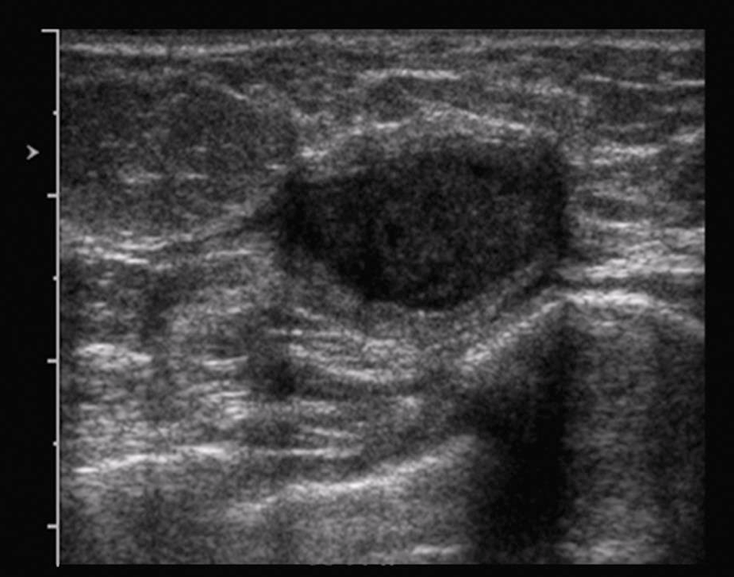 <p>cyst features worrisome for acute inflammation or infection include uniform isoechoic wall thickening, hyperemia of the cyst wall, and possible internal fluid debris level</p>