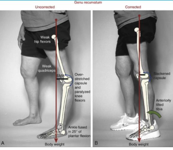 <ul><li><p><strong><u>Posterior structure laxity</u></strong></p></li><li><p>Chronic overpowering/<strong><u>excessive knee extensor torque</u></strong> due to poor postural control</p></li><li><p><strong><u>Neuromuscular disease</u></strong> (spastic quads or paralyzed/weak knee flexors)</p></li></ul><p></p>