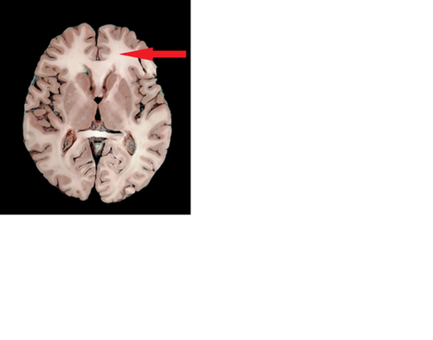 <p>tracts to and from the cerebral cortex - projection fibers, commissural fibers, association fibers</p>