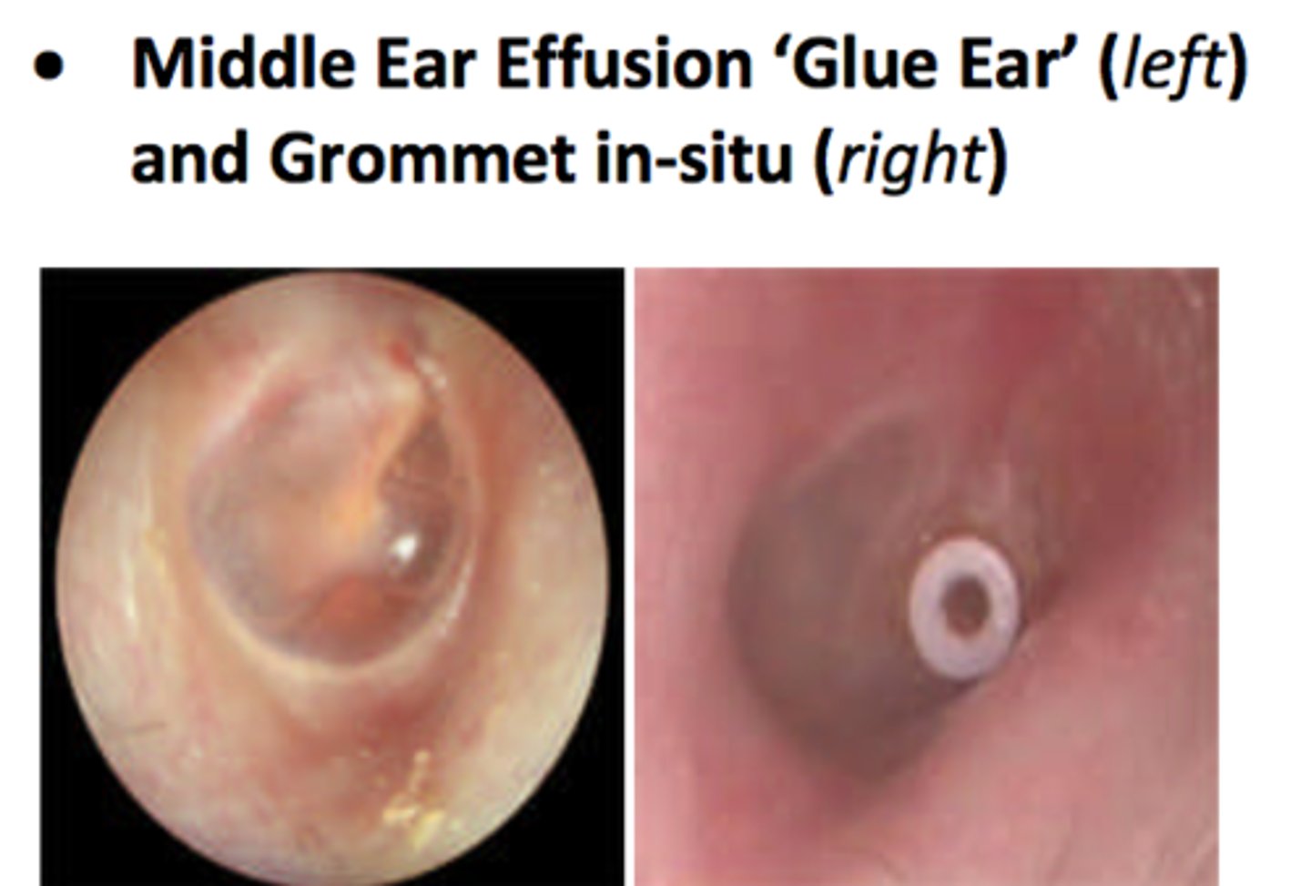 <p>a form of non-bacterial chronic otitis media; characterized by a persistent viscous effusion behind the ear drum</p><p>requires grommets if reoccurring or does not resolve</p>