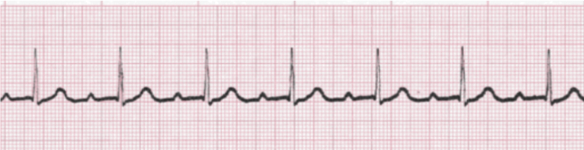 <p>Identify what type of heart block is shown! Discuss symptoms </p>