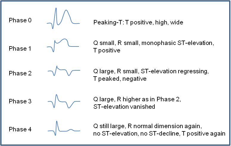 <p><strong>Persistent Q-waves, incomplete recovery of R-waves, and T-wave inversions.</strong></p>