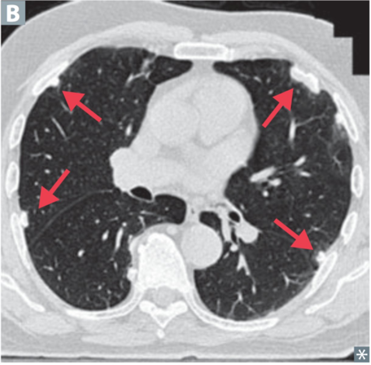<p>Inhalation of asbestos fibers leading to inflammation &amp; fibrosis; CT (tends to show most detail, but we often make this diagnosis in context of the patient's hx of asbestos exposure)</p>