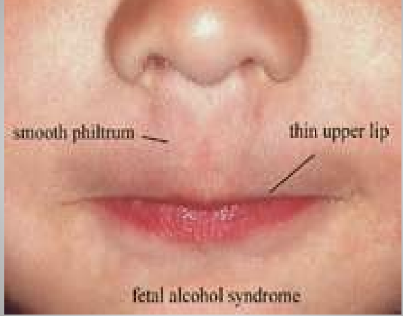 <p>Birth defects from prenatal alcohol exposure: smooth philtrum, thin upper lip, small palpebral fissures, growth delay, neurodevelopmental deficits.</p>