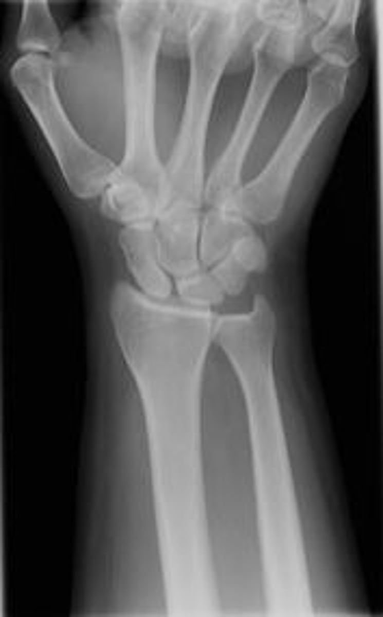 <p>-Distal radius, ulna, and carpals demonstrated</p><p>-Center of field at midcarpals</p><p>-No rotation</p><p>-open radioulnar joint space</p><p>-no excessive flexión of digits to overlap</p>