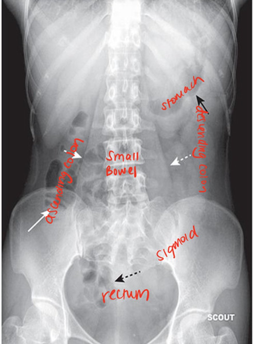 <p>air in the stomach, air in 2 or 3 loops of nondilated small bowel, air usually in rectosigmoid</p><p>depending on the amt of fat around visceral structures, their outlines may be partially visible</p>