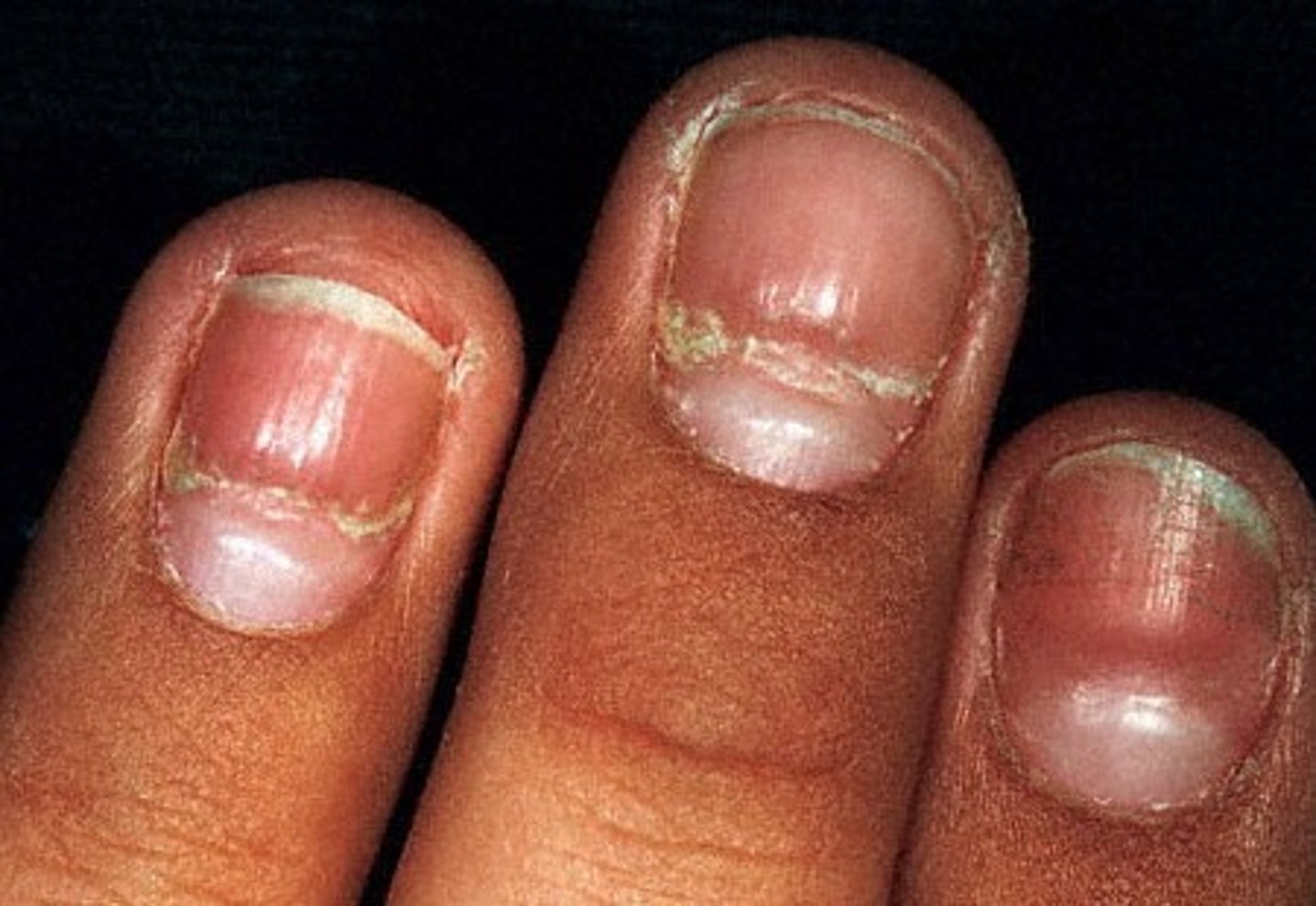 <p>indentations that run across the nail, growth air the area under the cuticle is interrupted by injury or severe illness, such as a heart attack or also a sign of malnutrition</p>