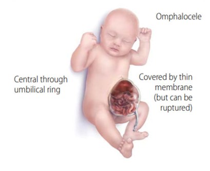 <p>Birth defect of abdominal wall where internal abdominal organs, like intestines and liver, stick out side of belly through belly button. “Sac” is protected by a thin translucent membrane. </p>