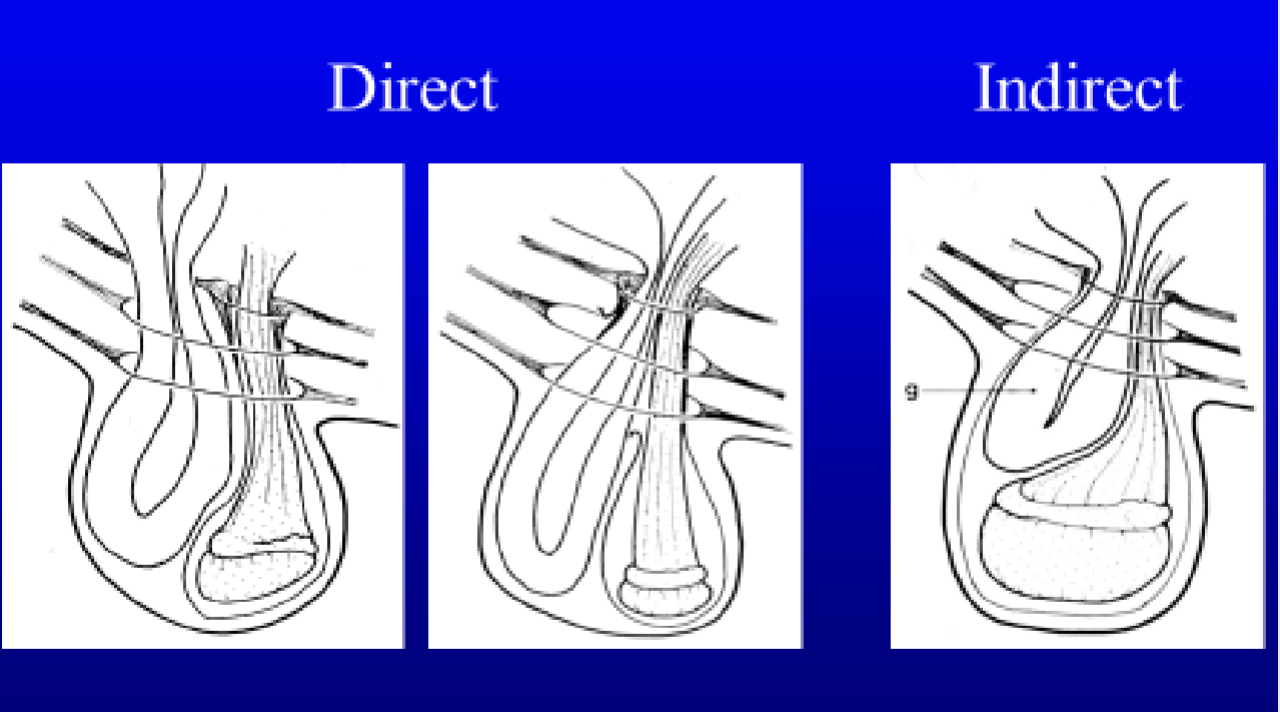 <ul><li><p><strong><span style="font-family: Times New Roman, serif">Indirect = Intestine within vaginal tunic - adjacent to the testicle</span></strong></p><ul><li><p><strong><span style="font-family: Times New Roman, serif">Only so much intestine can fit in here</span></strong></p></li><li><p><strong><span style="font-family: Times New Roman, serif">Vaginal tunic can rupture and become a direct hernia</span></strong></p></li><li><p><strong><span style="font-family: Times New Roman, serif">Much more common</span></strong></p></li><li><p><strong><span style="font-family: Times New Roman, serif">Content enters the inguinal canal via an abnormally large vaginal ring. The superficial and deep rings are normall.</span></strong></p></li></ul></li><li><p><strong><span style="font-family: Times New Roman, serif">Direct = direct defect in the peritoneum, intestine slipped down adjacent to the vaginal tunic =&nbsp; allows for more intestine to fit.&nbsp;</span></strong></p><ul><li><p>content passes through the body wall (internal oblique muscle) and into the inguinal canal</p></li><li><p>hernia content is outside the common tonic</p></li></ul></li></ul>