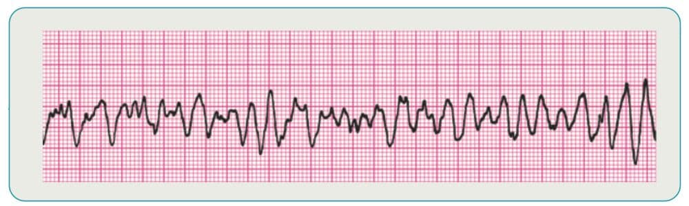 <p>ventricular fibrillation</p>