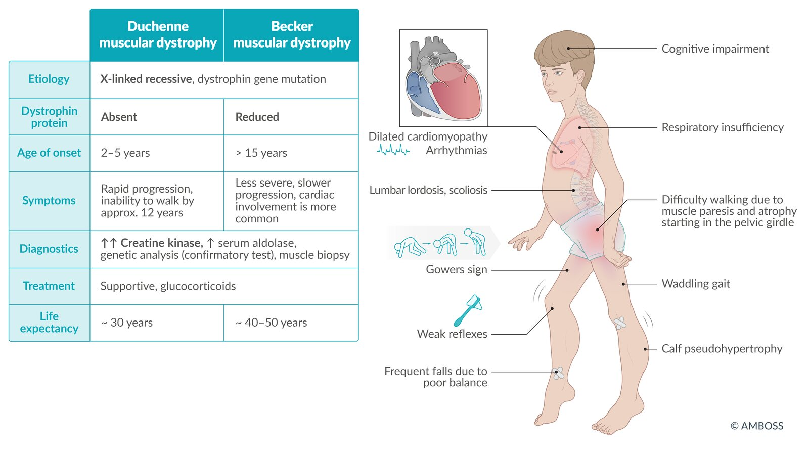 <p>DDx: <em>Dystrofia myotonica</em>: Ger myotoni (fördröjd muskelavslappning) och påverkar inte primärt benen.</p>
