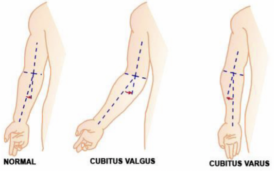 <p><span style="font-family: Calibri, sans-serif">When arms are held out at your sides and your palms are facing forward, forearm and hands should normally point about 5 to 15 degrees away from your body</span></p>