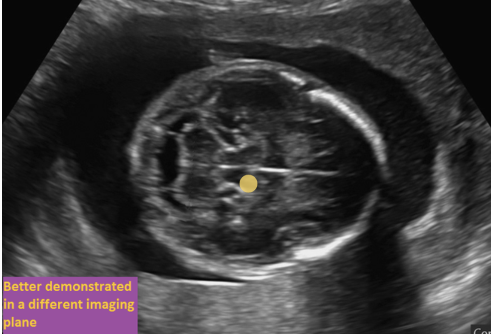 <p>fetal left side is posterior</p>