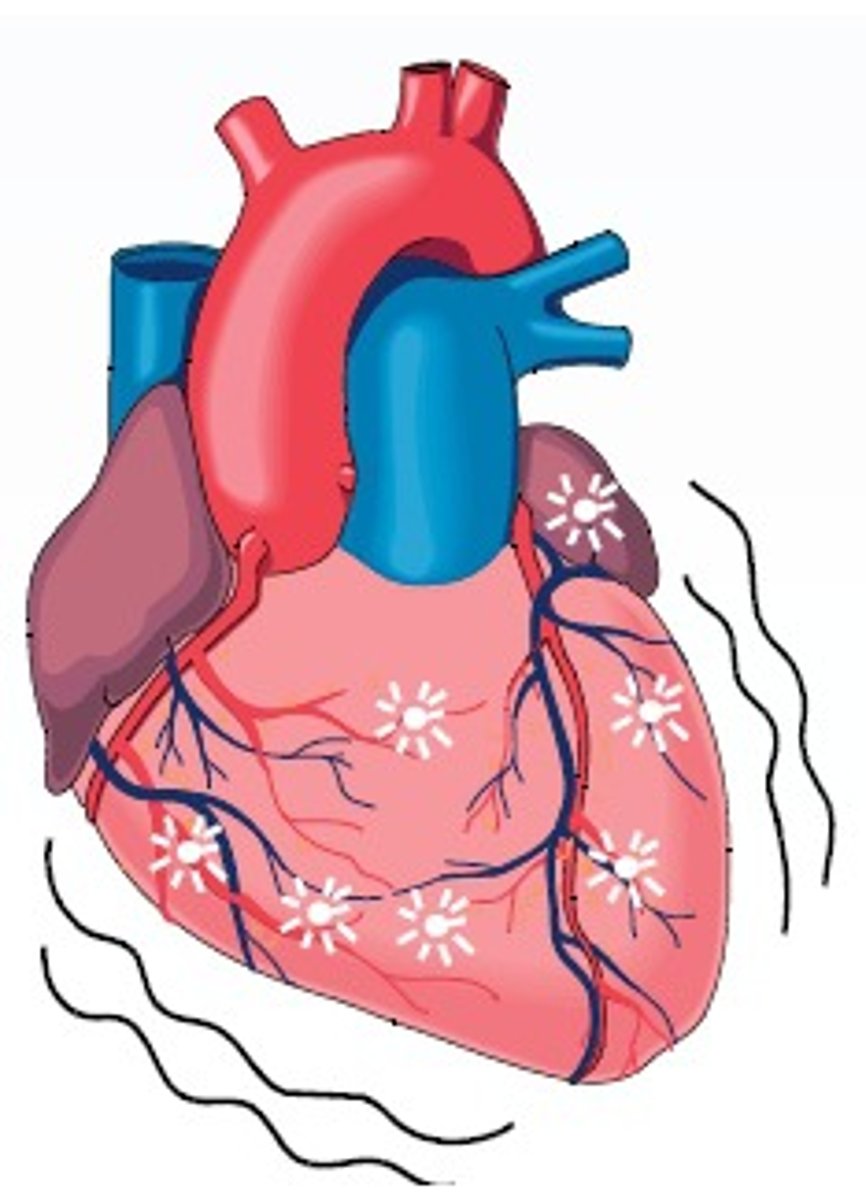 <p>when the heart stops beating due to stroke, severe injuries, electrical shock, drug overdose, chest trauma, drowning or suffocation. Leads to unconsciousness, no pulse, no signs of circulation</p>