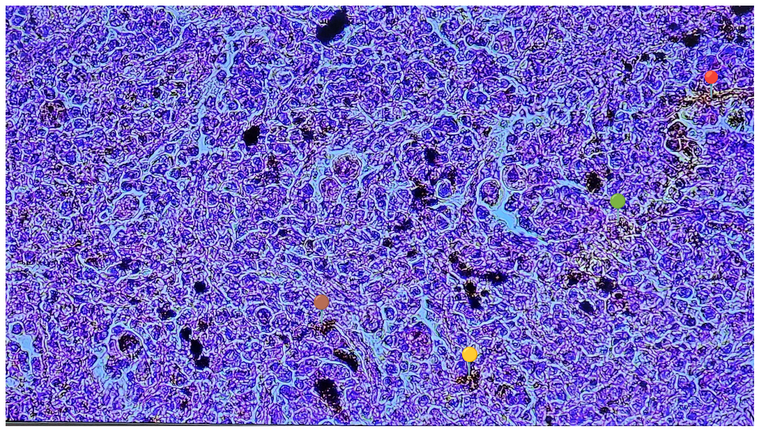 <p><strong><em>Plasmodium sp.</em></strong></p><p>(śledziona - malaria melanemia)</p><p></p><p></p><p><strong>Cechy charakterystyczne</strong>:</p><p></p><ul><li><p><span data-name="red_circle" data-type="emoji">🔴</span><span data-name="yellow_circle" data-type="emoji">🟡</span><span data-name="green_circle" data-type="emoji">🟢</span><span>️</span><span data-name="brown_circle" data-type="emoji">🟤</span><span> - złogi hemosyderyny.</span></p></li></ul><p></p><p></p><p><strong>Parazytoza</strong>: <em>Malaria</em></p><p></p>