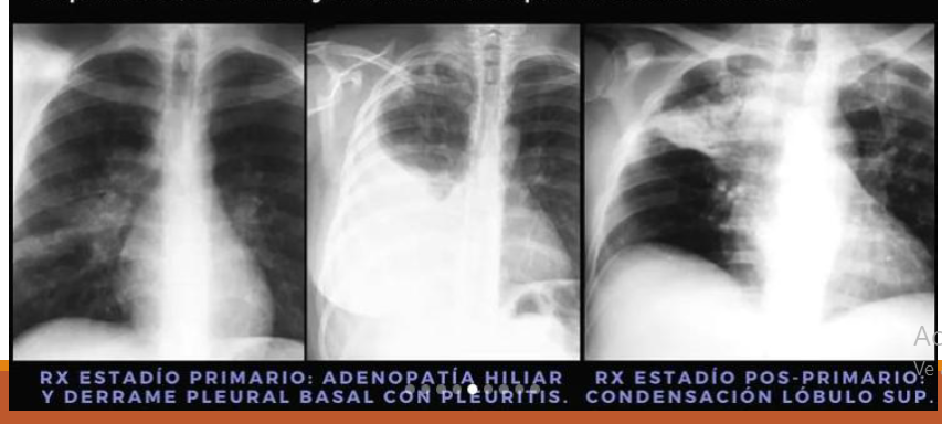 <p>Prevalencia en la zona 1 de WEST</p><ul><li><p><strong>Primer método de aprox dx</strong></p></li><li><p><span style="color: red"><strong>Rx de torax en estadíos primarias:</strong></span></p><ul><li><p><span style="color: red"><strong>Linfoadenopatías</strong></span></p></li><li><p><span style="color: red"><strong>Micronodulaciones y excavaciones</strong></span></p></li></ul></li><li><p><span style="color: red"><strong>Rx de torax en estadios pos-primarios</strong></span></p><ul><li><p><span style="color: red"><strong>Excavaciones por necrosis caseosa</strong></span></p></li></ul></li></ul><p></p>