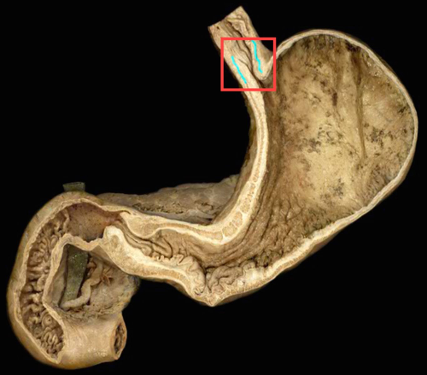 <p>lower valve at the end of the esophagus and at the entrance of the stomach</p>