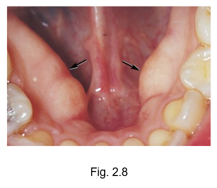 <ul><li><p>developmental growth of bone present on the lingual surface of the mandibular arch with a possible hereditary etiology similar to exotoses </p></li><li><p>may be associated with grinding, also known as bruxism </p></li></ul><p></p>