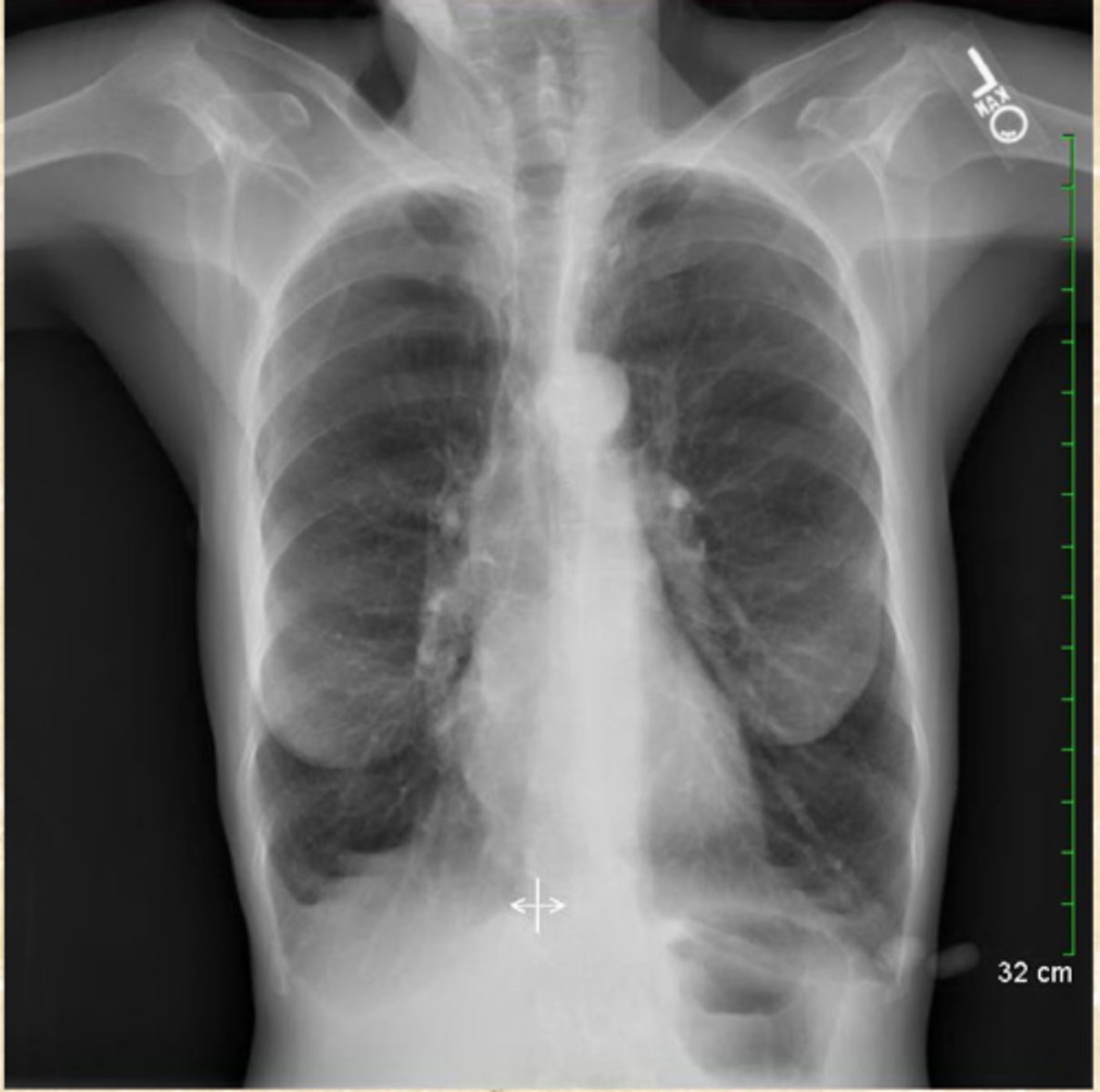 <p>What is this Patient's Dx?</p><p>How do you know?</p>