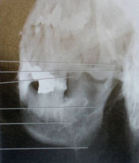 <p>25° cephalic, enters ramus at Area of interest (ROI)</p>