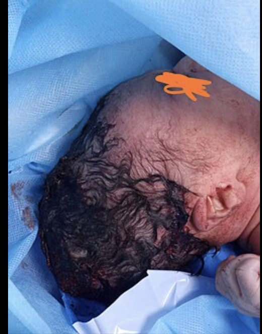 <p>Edema over the periosteum that crosses suture lines </p>