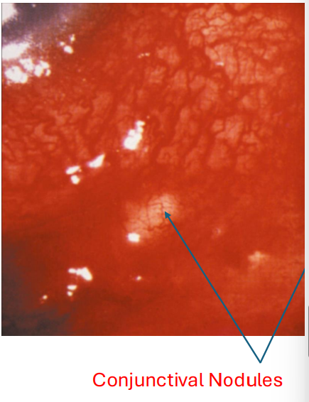 <ol><li><p>Characterized as a granulomatous conjunctivitis with lymphadenopathy</p></li><li><p>has conjunctival nodules </p></li></ol><p></p>