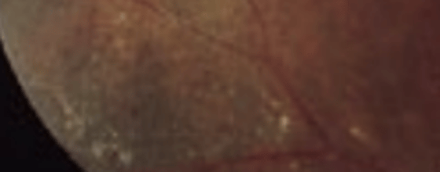 <p>a mild variant of Coat's disease, having minimal exudation.</p>