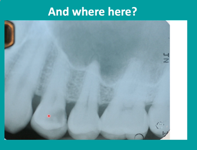 <p>radiolucency </p>