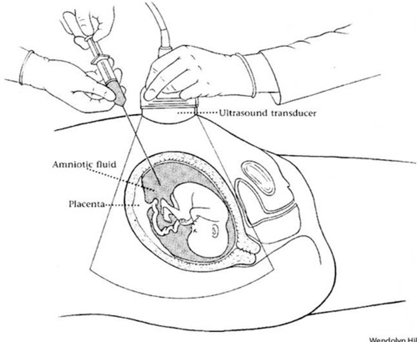 <p>Reduces polyhydramnios</p><p>No more than 3L at a time</p><p>60% survival of 1 twin</p><p>Not effective in severe stages of TTTS</p>