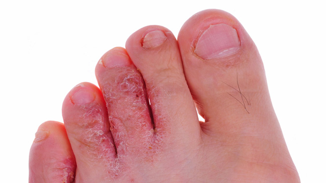 <ul><li><p>Caused by Tinea pedis (fungal infection)</p></li><li><p>Itchy, red peeling skin between toes</p></li></ul><p></p>