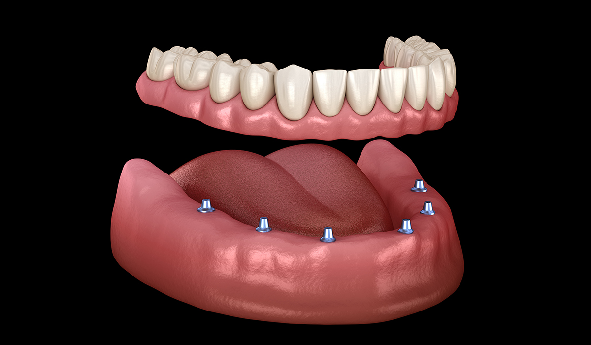 <p>A denture that fits over remaining natural teeth or implants for extra support.</p>