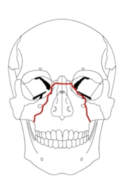 <p>Pyramidal fracture through the maxilla, orbital tib, nasal bridge, and hard palate</p><p>(nose and mouth mobile)&nbsp;</p>