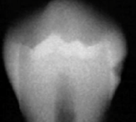 <p>caries classification?</p>