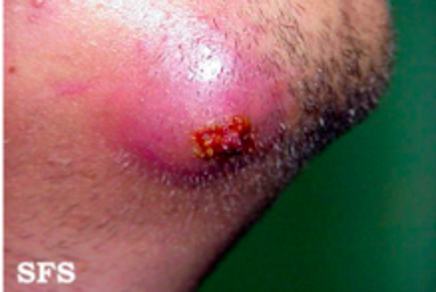 <p>Bacterial Skin Infections:</p><p>a deeper infection composed of<strong> interconnecting furuncles</strong></p><p><strong>- "boil," "abscess"</strong></p>