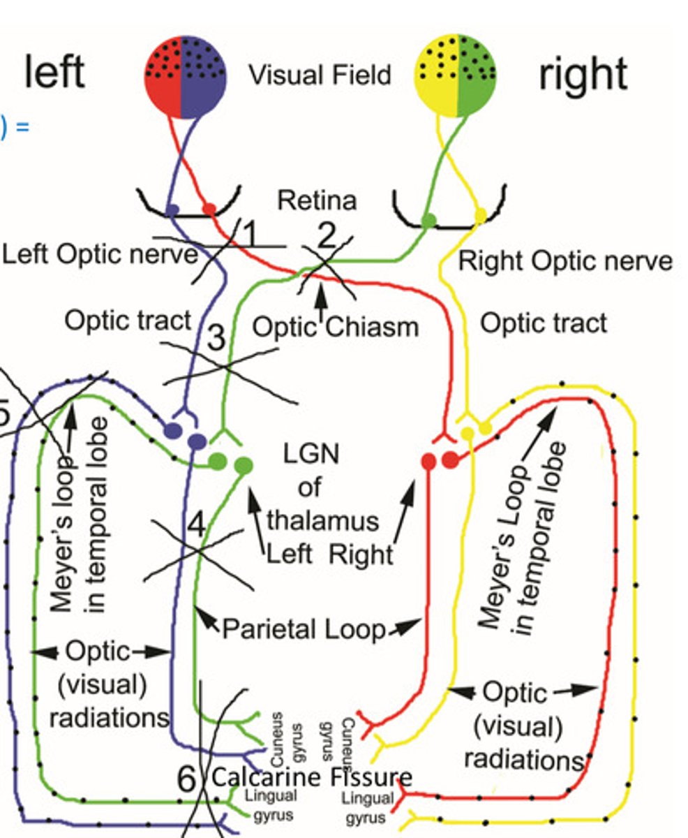 <p>which area will cause contralateral homonymous superior quadrantopsia when lesioned?</p>