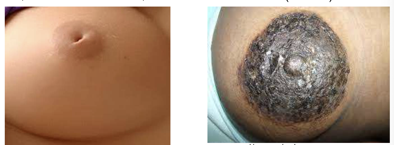<ul><li><p>Nipple retraction (can be normal OR abnormal) </p></li><li><p>Paget’s Disease (abnormal) </p><ul><li><p>covered in eczema/scales </p></li></ul></li></ul><p></p>