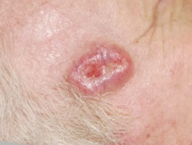 <p>What is the treatment for basal cell carcinoma (BCC)?</p>