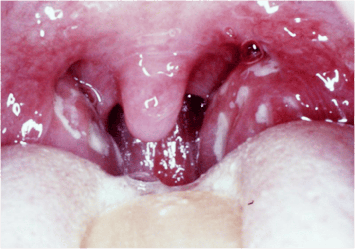 <p>стрептококковая ангина</p>