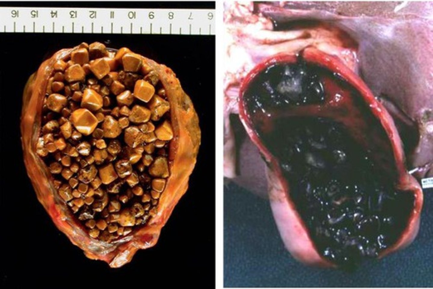 <p>Define Condition:</p><p>Yellow/Yellow-brown stones in gallbladder</p><p>-Hx:</p><p>&gt; MC in Western countries</p><p>&gt; Risks that Increase Cholesterol:</p><p>&gt;&gt; Increased ESTROGEN</p><p>&gt;&gt;&gt; Female (older)</p><p>&gt;&gt;&gt; OCPs</p><p>&gt;&gt;&gt; Pregnancy (biliary peristalsis --&gt; Increase stasis)</p><p>&gt;&gt; Obesity (Increase total body cholesterol)</p><p>&gt;&gt; Rapid Weight LOSS (Increase cholesterol metabolism)</p><p>-Dx:</p><p>&gt; Labs:</p><p>&gt;&gt; Low Cholesterol</p><p>&gt;&gt; Low Bile Salts</p><p>&gt;&gt; HIGH BILE STASIS ==&gt; Supersaturation of bile w/ cholesterol --&gt; precipitation of cholesterol in bile</p><p>&gt; Imaging:</p><p>&gt;&gt; XRay = RADIOLUCENT</p><p>-Tx:</p><p>&gt; Cholecystectomy</p><p>&gt; Alternative = Ursodeoxycholic Acid (Bile Acid that causes less secretion of cholesteroll into bile; may dissolve cholesterol stones)</p><p>-Prog:</p><p>&gt; Biliary Colic</p><p>&gt; Choledocholithiasis</p><p>&gt; Acute/Chronic Cholecystitis</p><p>&gt; Porcelain gallbladder</p><p>&gt; Ascending/Acute Cholangitis</p><p>&gt; Gallstone Ileus</p>