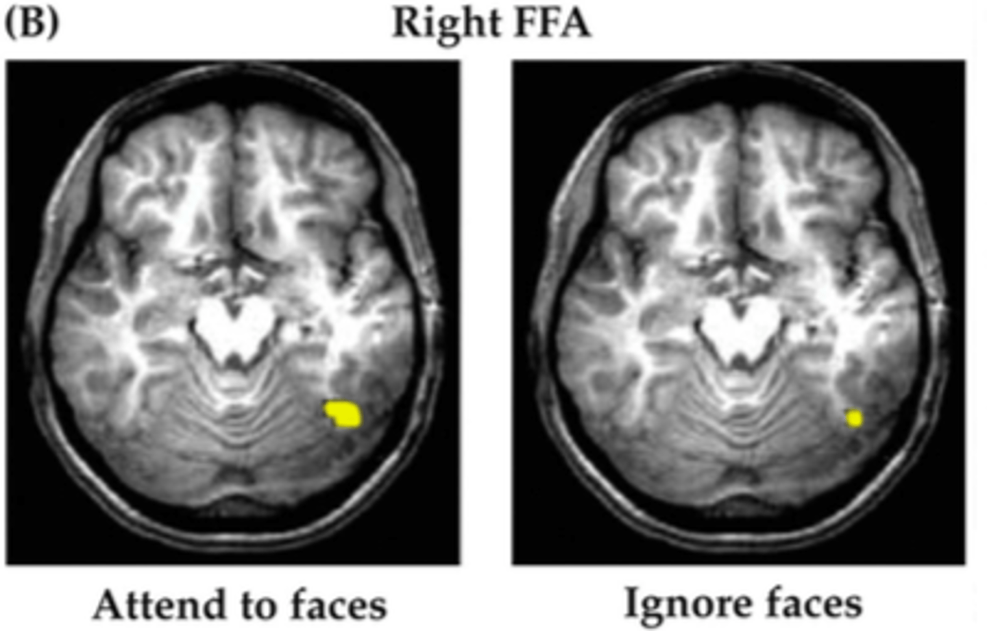 <p>dorsal (back) of head right hemishpere as in diagram.</p>