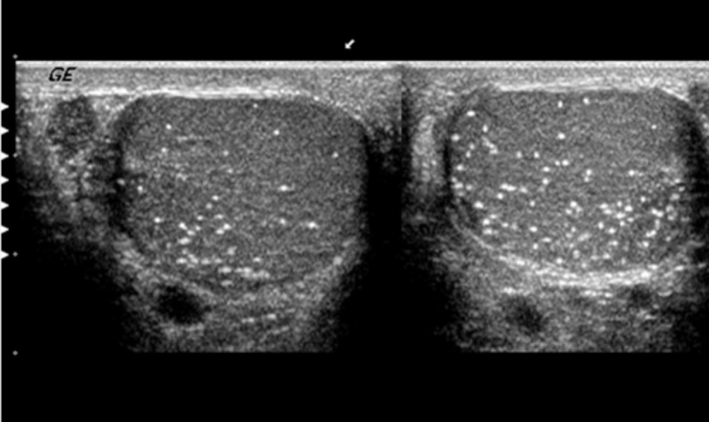 <p>What pathology is present in this image?</p><p>a. spermatocele</p><p>b. seminoma</p><p>c. microlithiasis</p><p>d. metastatic disease</p><p>e. orchitis</p>
