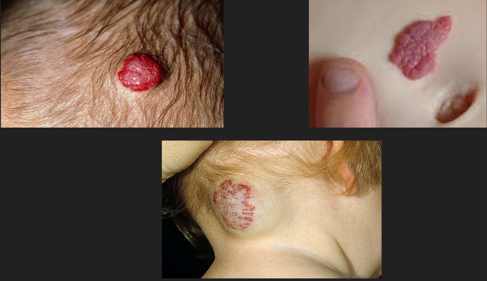 <p>What are some parent teachings for vascular tumors? </p>