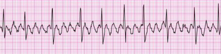 <p>P waves replaced by F waves with sawtooth appearance</p><p>ectopic focus in atria depolarizes repetitively at a rate of 250-350 bpm</p><p>rhythm: regular</p><p>rate: normal or elevated, determined <strong>only</strong> by ventricular depolarization, conduction ratio can be 2:1 up to 8:1</p><p>P waves replaced by rapid F waves</p><p>no PR interval</p><p>normal narrow QRS</p><p>implications: hemodynamically stability depends on ventricular rate</p>